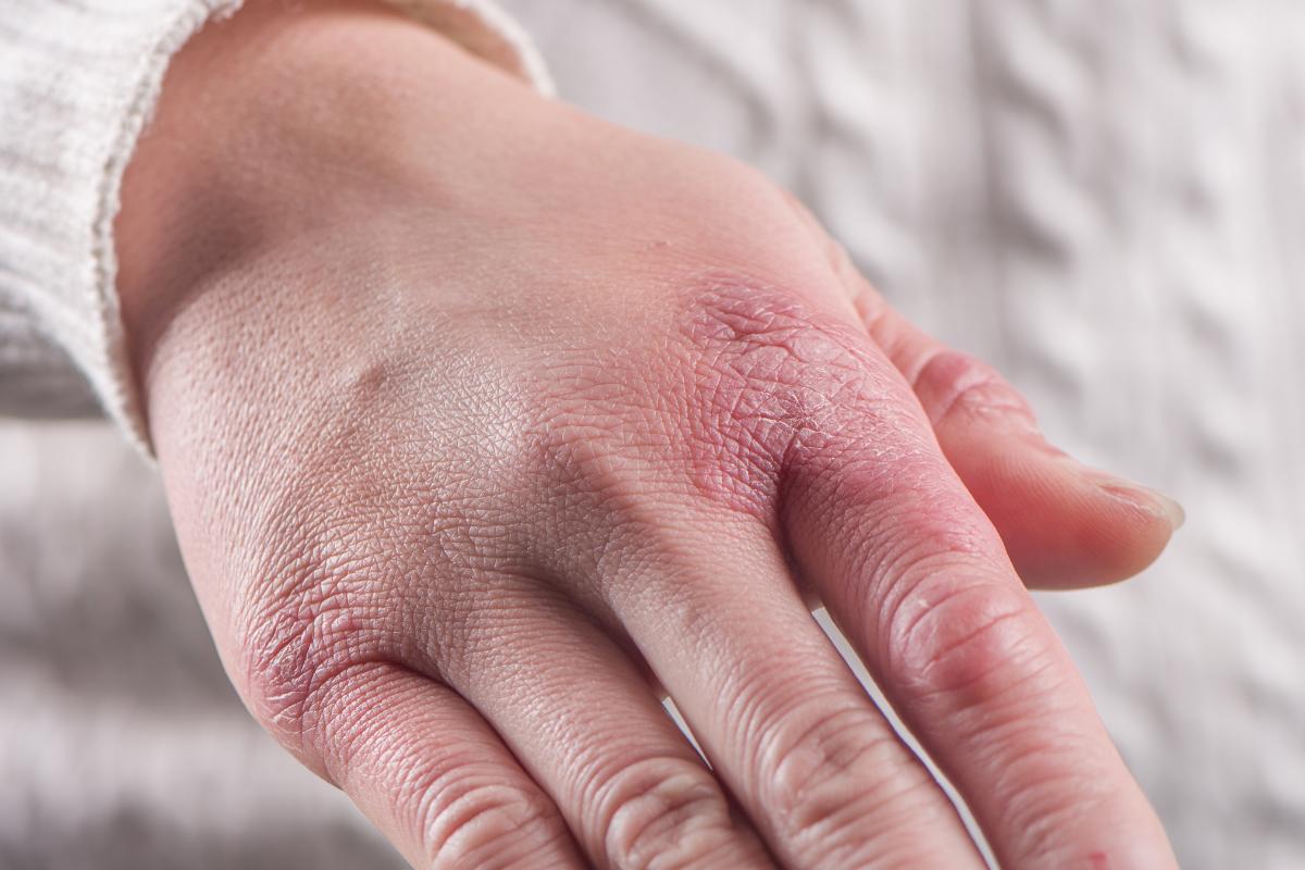 Sabañones en las manos: causas, cómo curarlos y cómo puedes evitarlos