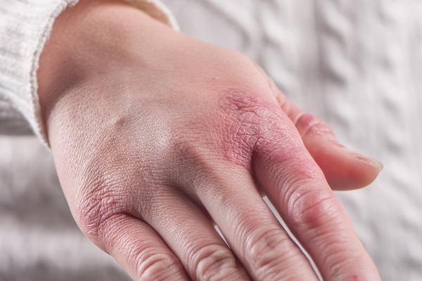 Sabañones en las manos: causas, cómo curarlos y cómo puedes evitarlos