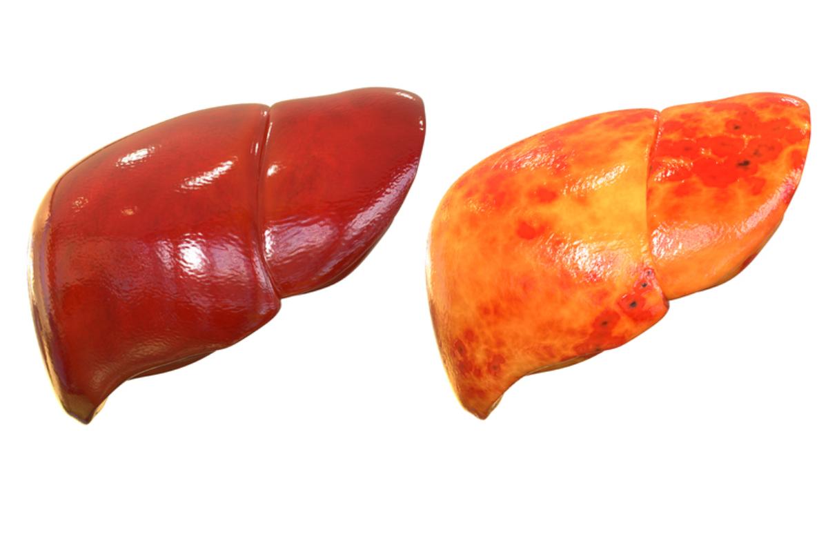 Remedios caseros para el hígado inflamado