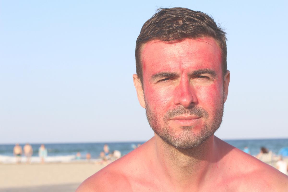 Cómo quitar quemaduras de sol en la cara