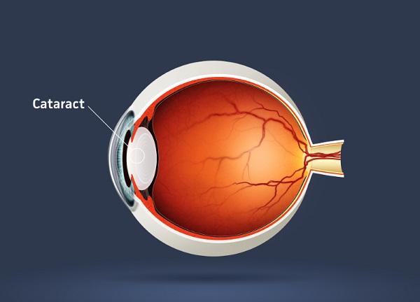 Por qué se producen las cataratas - Paso 1