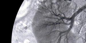 Cómo tratar el cáncer de próstata, de riñón y de vejiga