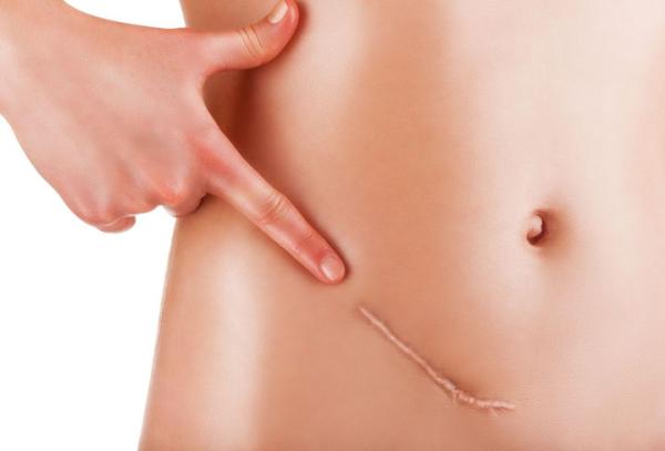 Cómo hacer que una cicatriz cure rápido y sin marcas