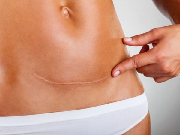 Cómo hacer que una cicatriz cure rápido y sin marcas - Limpieza de una cicatriz: para prevenir las marcas