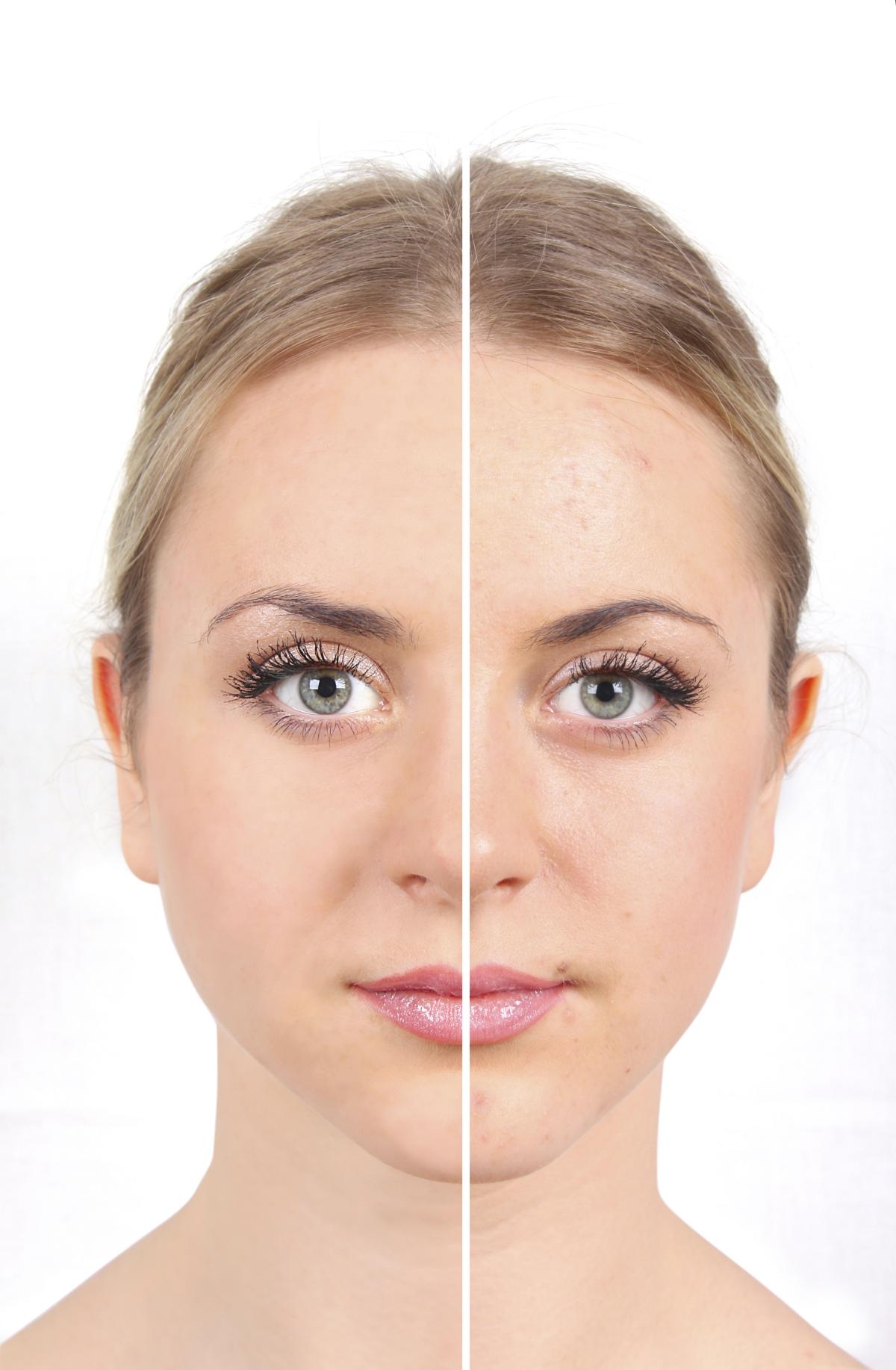 Cómo eliminar las manchas de acné