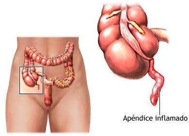 Cómo se manifiesta la peritonitis aguda