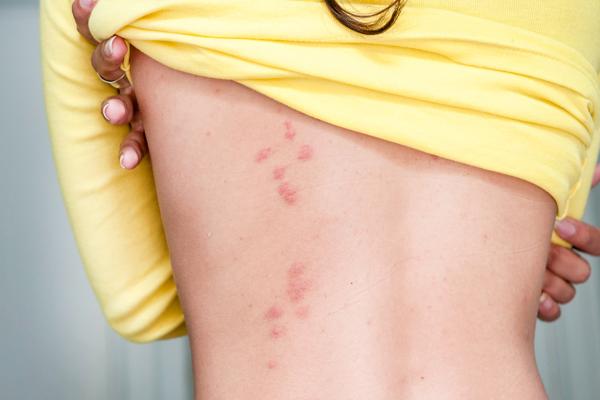 Cómo quitar las cicatrices de picaduras de chinches