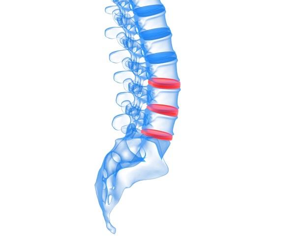 Por qué me duele la espalda - Paso 4