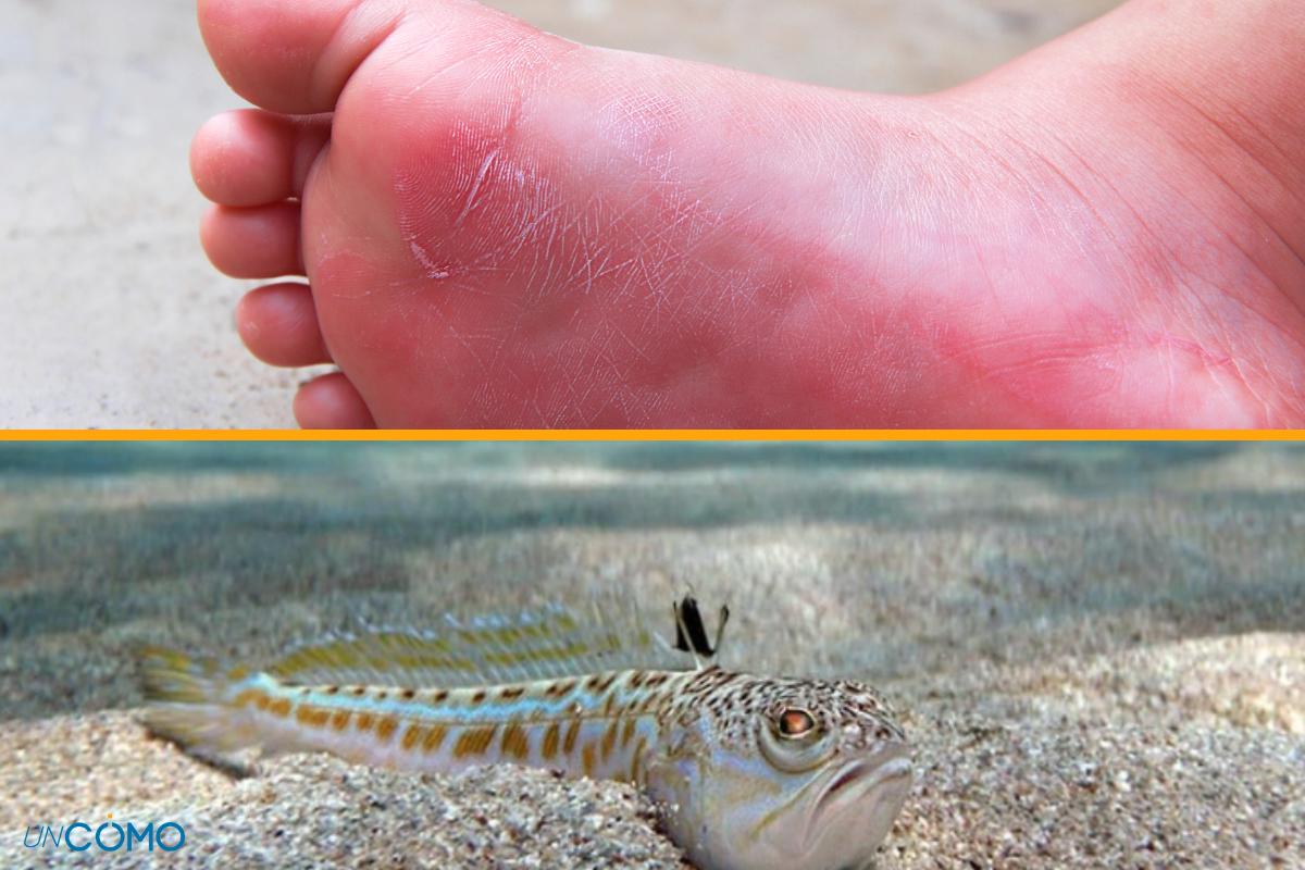 Picadura de pez araña: qué hacer y cuánto dura