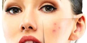 Cómo tapar los granos con maquillaje