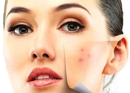 Cómo tapar los granos con maquillaje