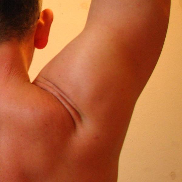 Ejercicios para la artritis de hombro