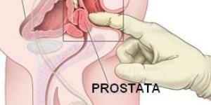 Cómo hacerme un autoexamen de próstata