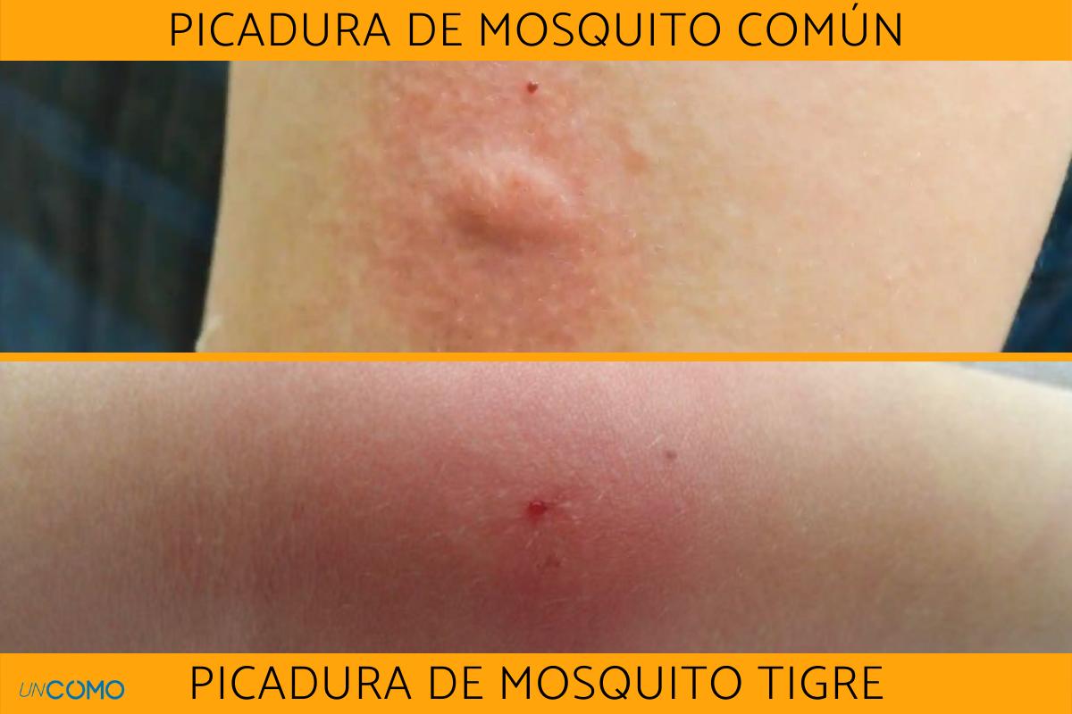 Diferencia entre la picadura de mosquito y la de mosquito tigre