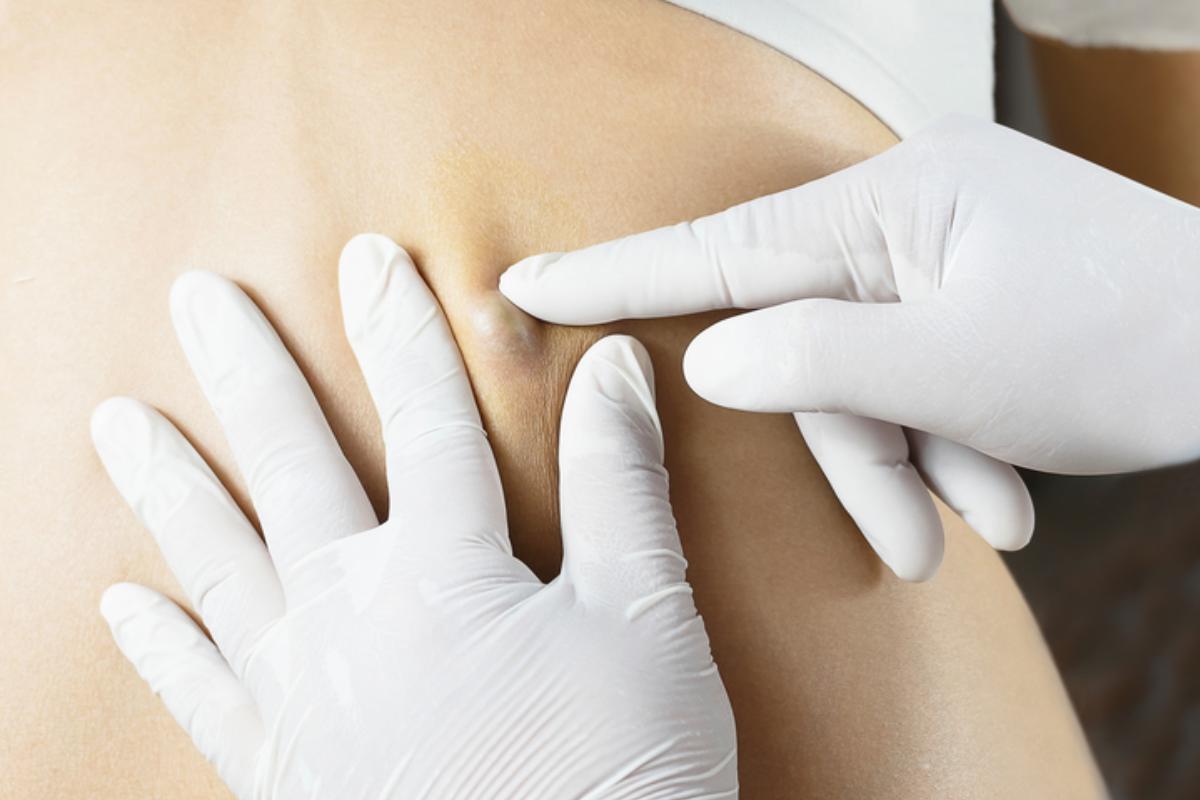 Cómo eliminar un quiste sebáceo sin cirugía - Remedios muy efectivos