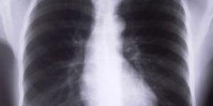 Cómo tratar una inflamación de la pleura