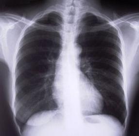 Cómo tratar una inflamación de la pleura