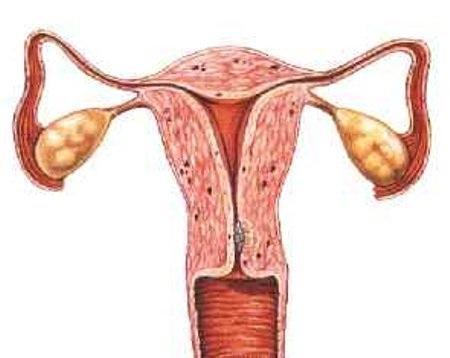 Cómo prevenir el Virus del Papiloma Humano VPH