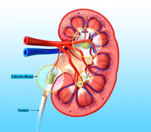 Cómo prevenir los cálculos renales