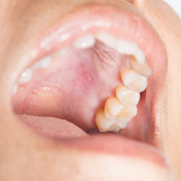 Tratamiento natural para el liquen plano oral