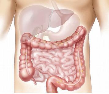 Cómo tratar el prolapso intestinal o caída intestinal