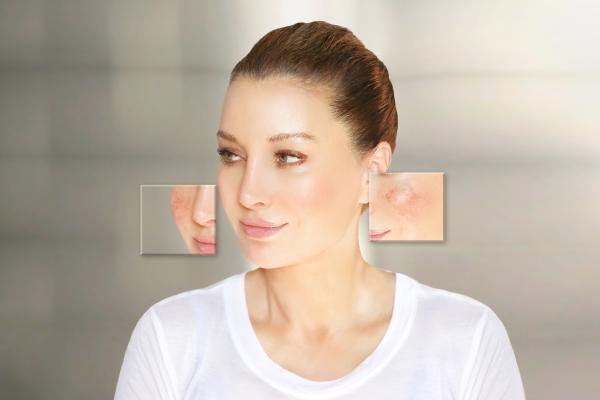 Cómo quitar lo rojo de un grano - Cómo bajar la inflamación de un grano rápidamente 