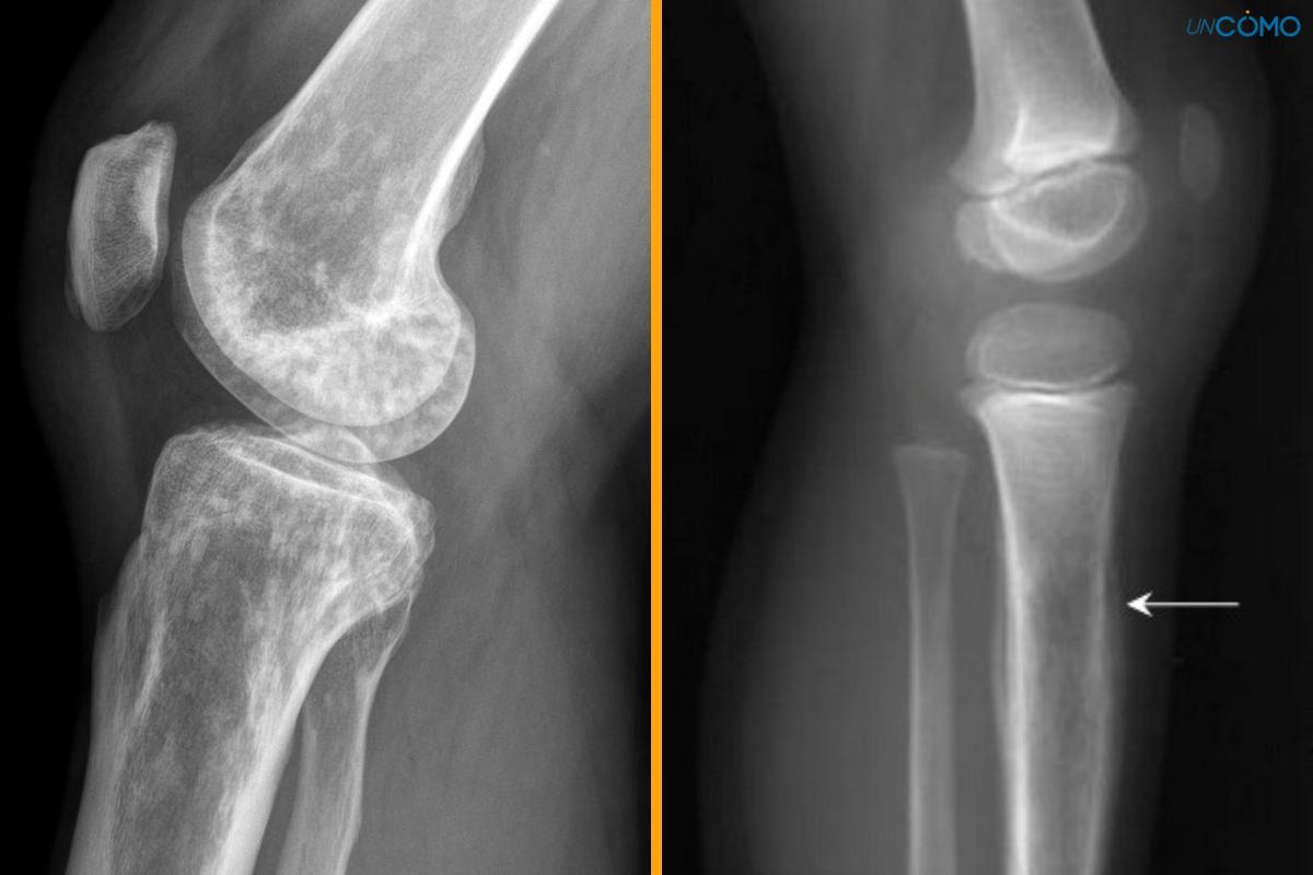 ¿El sarcoma de Ewing tiene cura?