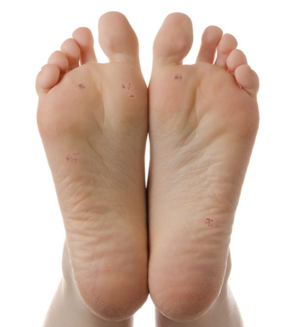 Por qué salen las verrugas