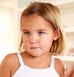 Cómo tratar el sarampión