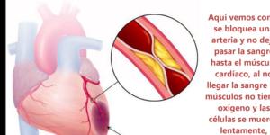 Cómo se sufre un infarto de miocardio
