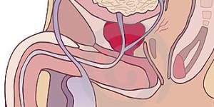 Prostatitis - causas, síntomas y tratamiento
