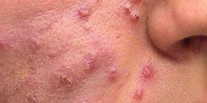 Cuáles son los síntomas del acné adulto