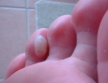 Cómo curar las ampollas en manos y pies