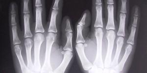 Cuáles son los síntomas de la artritis reumatoide