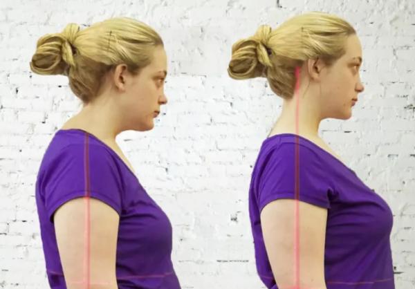 Joroba de búfalo: cómo eliminarla y ejercicios - Qué es la joroba de búfalo y cuáles son sus causas