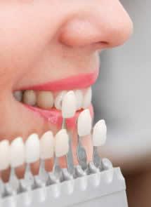 Cómo cuidar las carillas de composite