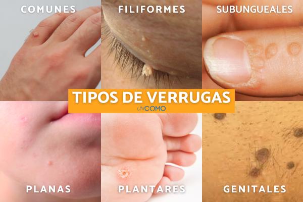 Vinagre de manzana para las verrugas - Tipos de verrugas y por qué salen 