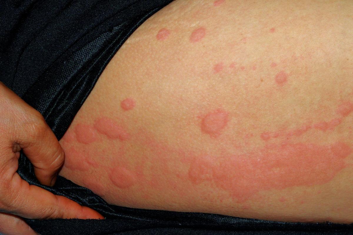Urticaria por frío: qué es y cómo curarla