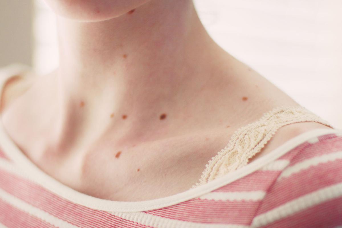 Vinagre de manzana para las verrugas