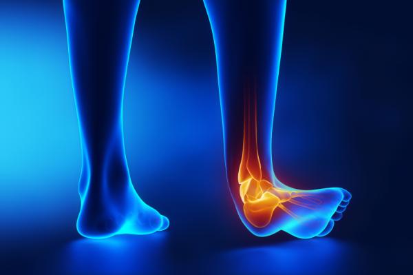 Cuánto tarda en curar un esguince - Causas y síntomas de un esguince