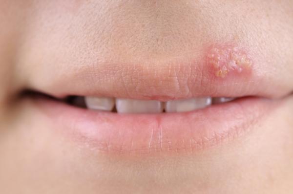 8 enfermedades transmitidas por la saliva - Herpes labial