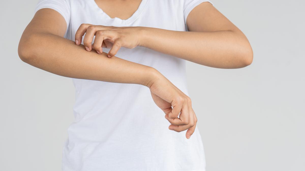 Remedios caseros para los sabañones