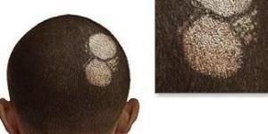 Cómo diagnosticar la tiña