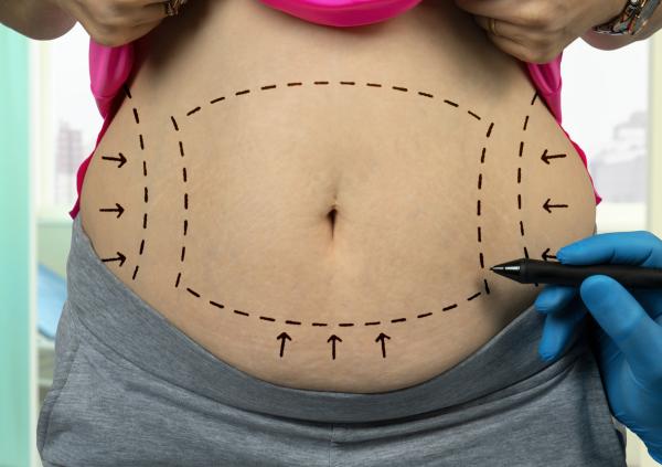Qué es una abdominoplastia y cómo se realiza