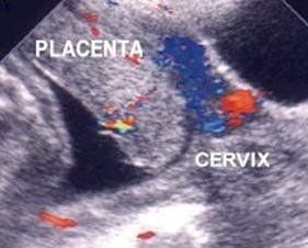 Cómo evoluciona el desprendimiento prematuro de la placenta