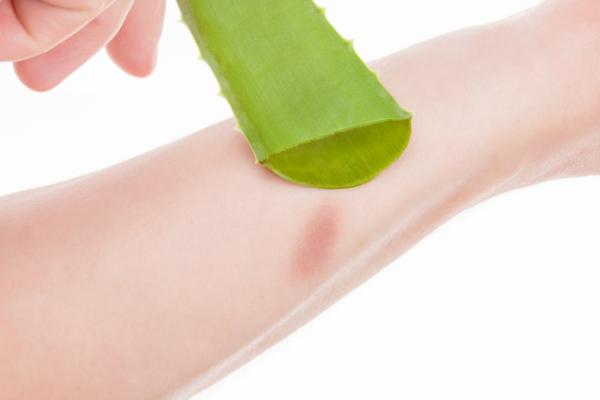 Cómo usar el aloe vera para las quemaduras