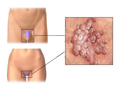 Cómo curar las verrugas genitales de forma natural