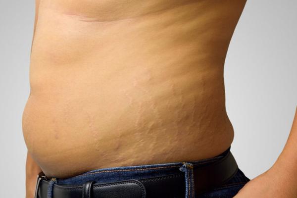 Estrías en hombres: por qué salen y cómo quitarlas - Cómo quitar estrías en hombres con remedios caseros