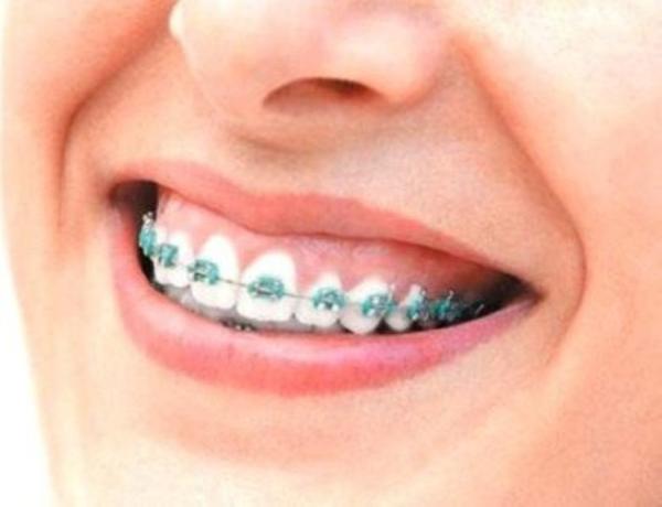 Cómo aliviar el dolor causado por los brackets