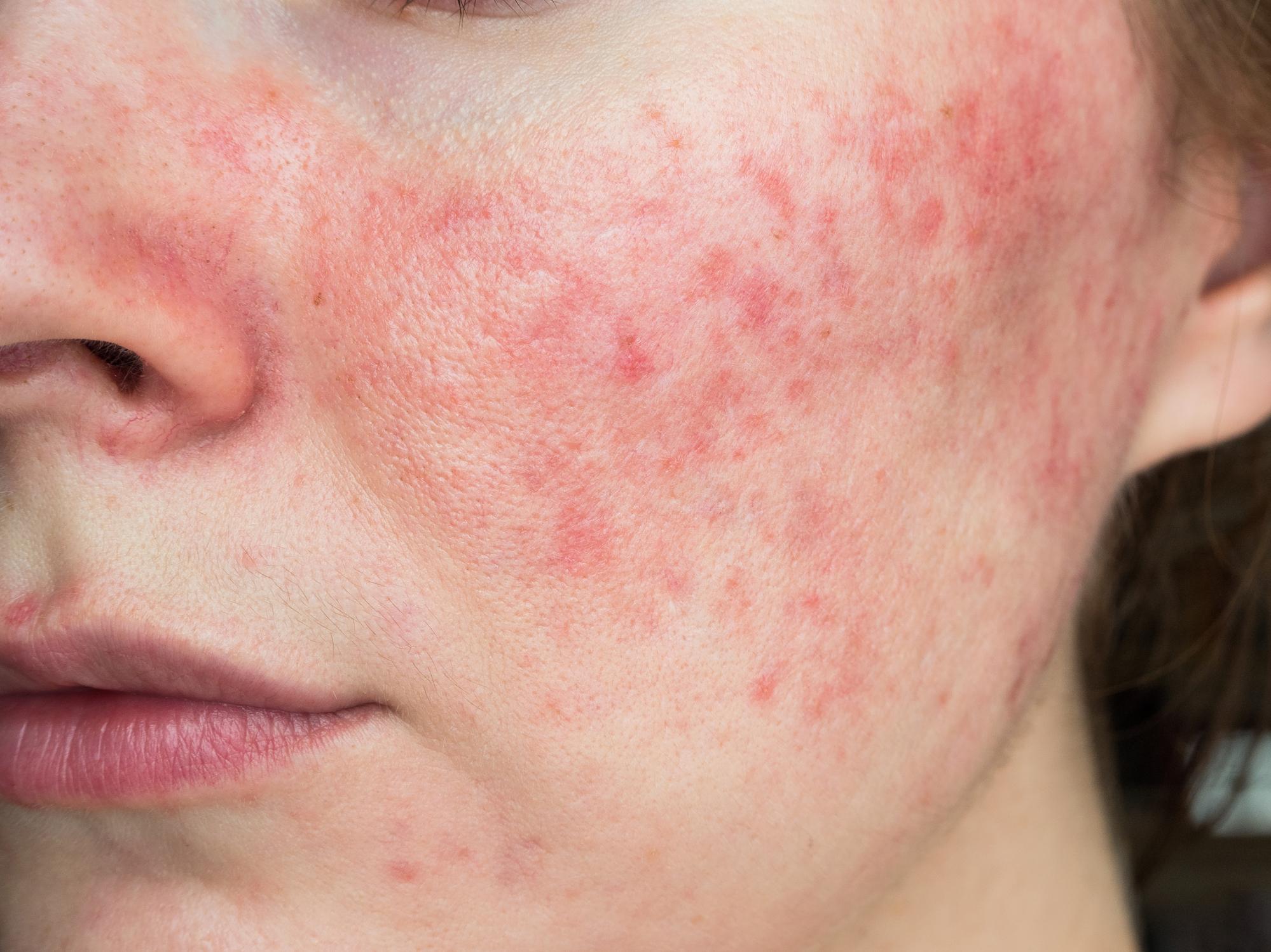 Cómo maquillarse con rosácea - Consejos para no dañar la piel a la hora de  aplicar maquillaje